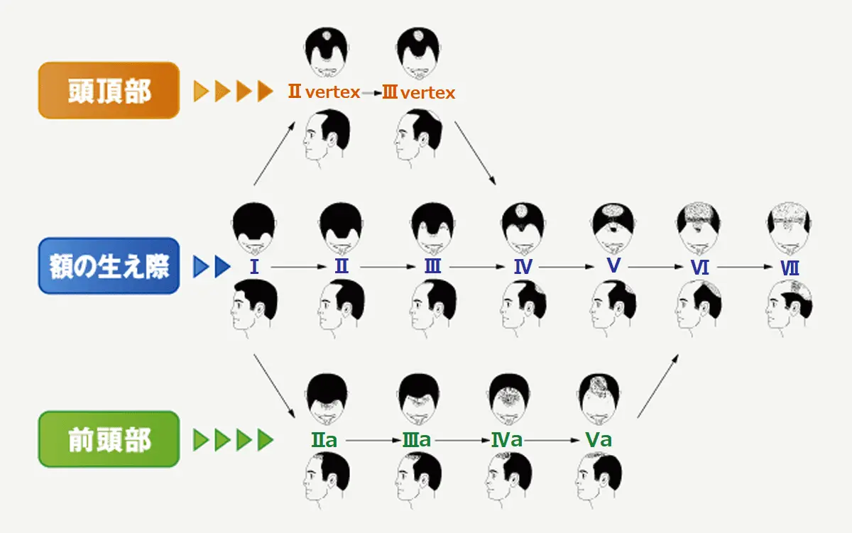 ハミルトン・ノーウッド分類によるAGA進行度の分類図