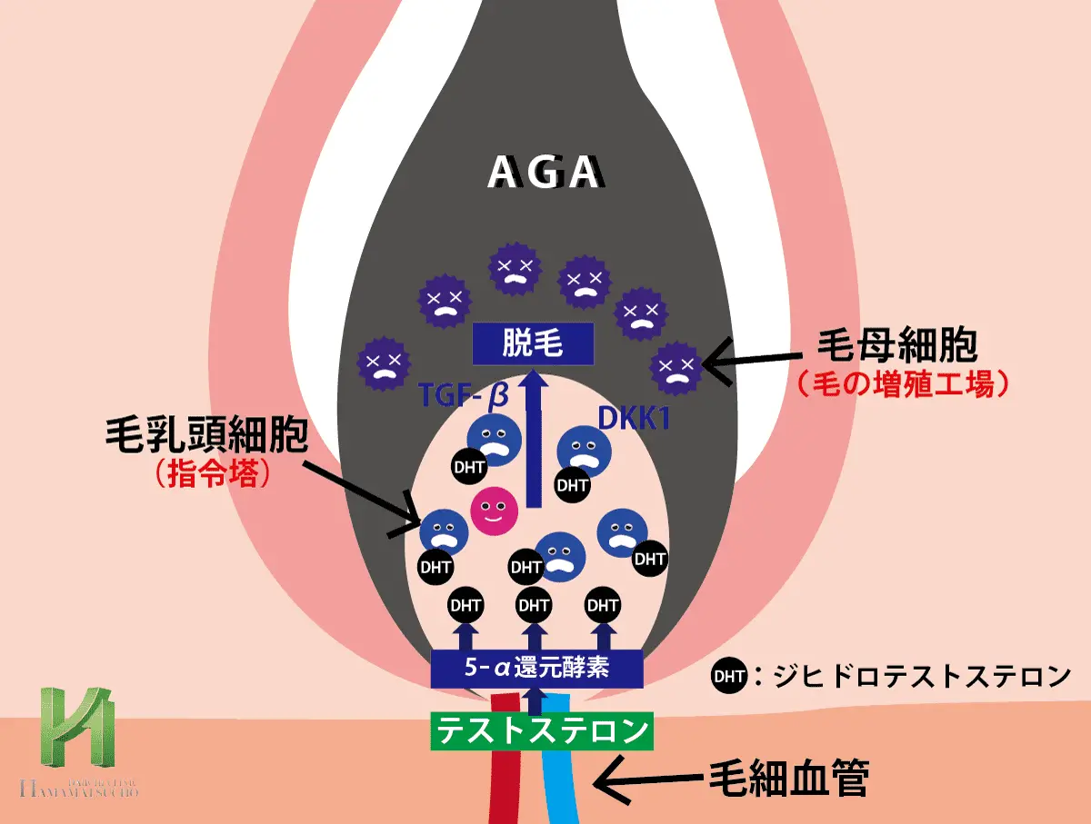 DHTの影響を受けたAGA患者の毛乳頭細胞と髪の成長阻害の仕組み
