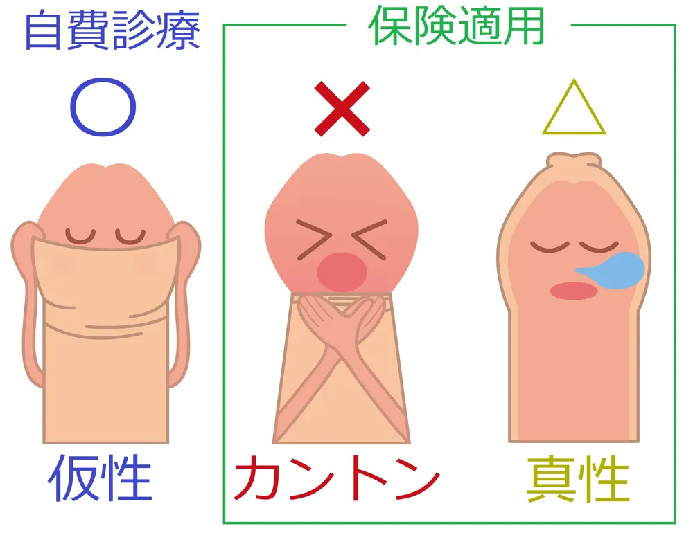 3種類の包茎図解
