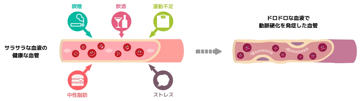 正常な血管と動脈硬化が進んだ血管の比較