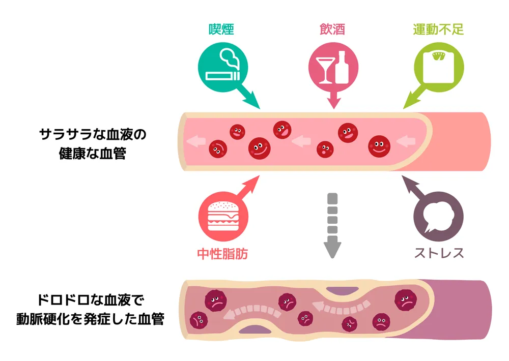 正常な血管と動脈硬化の血管の比較