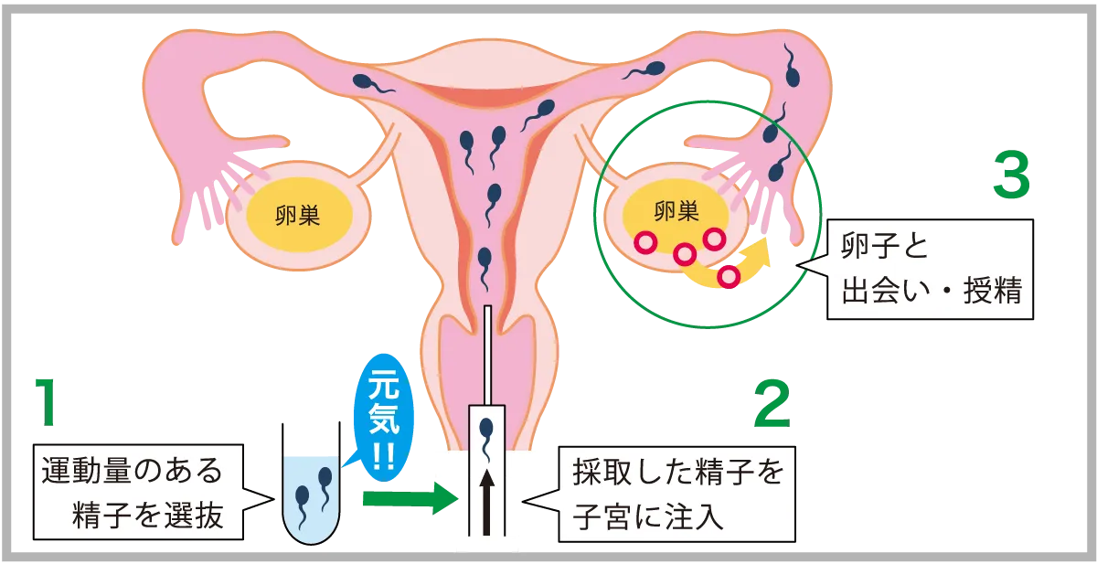 人工授精の仕組み