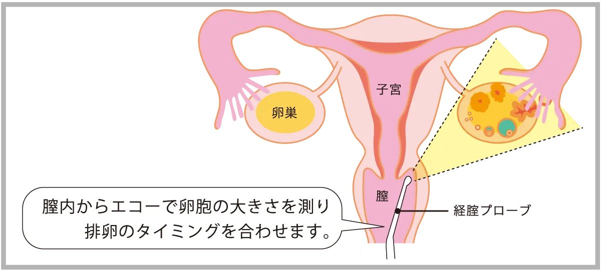 卵胞エコー検査図