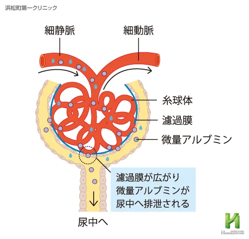 糖尿病性腎症による糸球体のダメージ