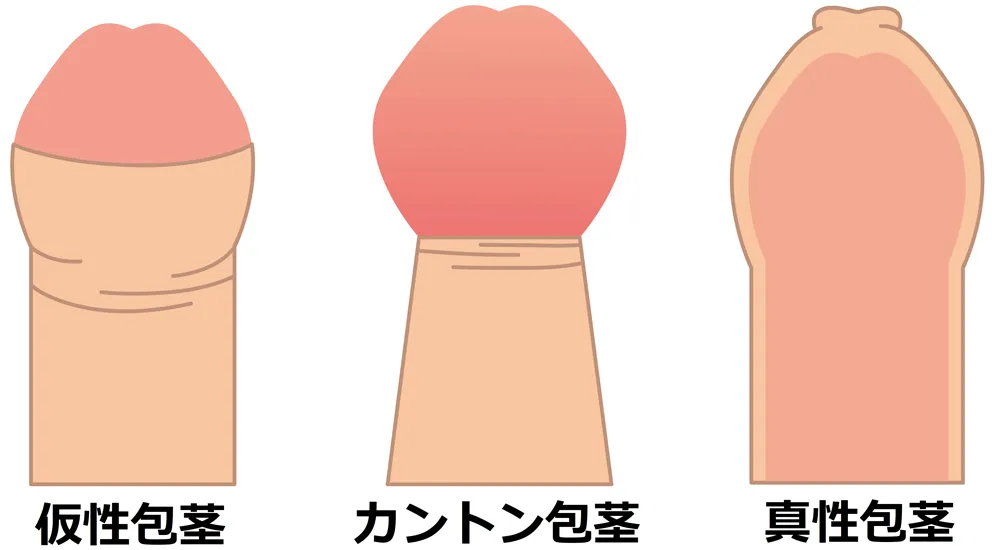 3種類の包茎