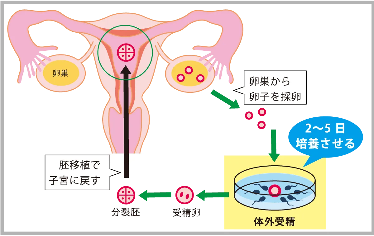 体外受精の流れ