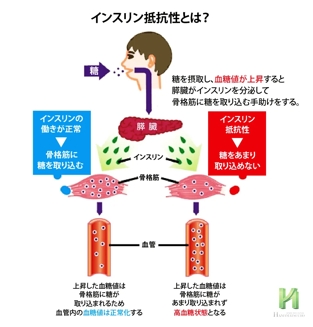 インスリン抵抗性の図解