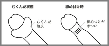 カントン包茎図解