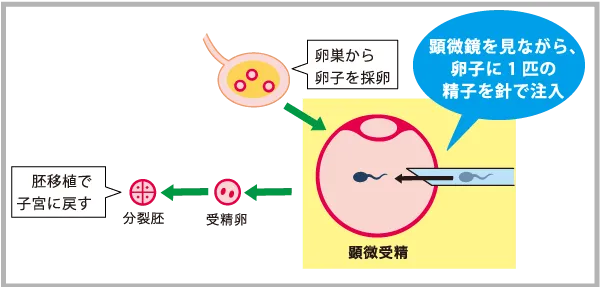 顕微授精のイメージ