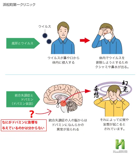 統合失調症の原因イメージ
