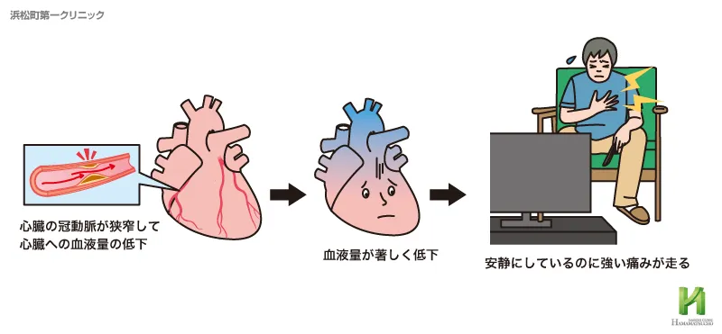 異型狭心症