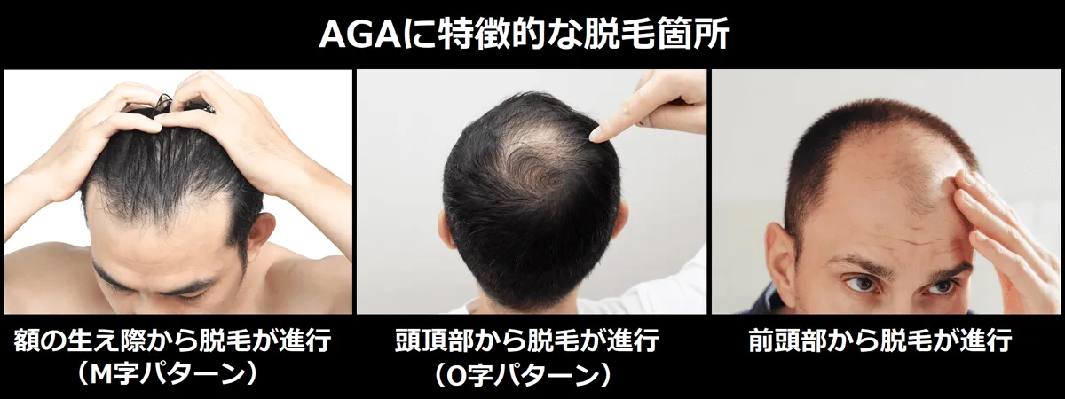 M字型・O字型・U字型に分類されるAGAの脱毛パターン図