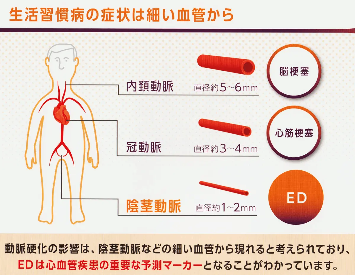 動脈硬化の症状は細い血管から