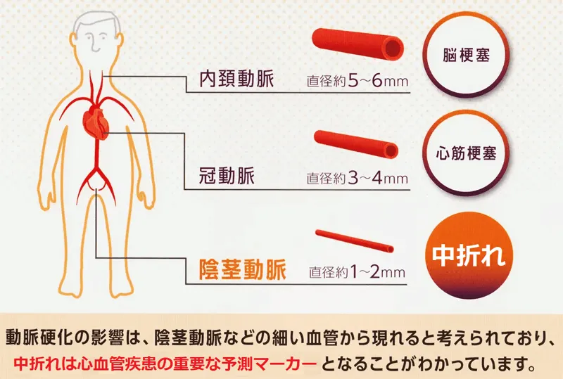 中折れは動脈硬化侵攻の指標