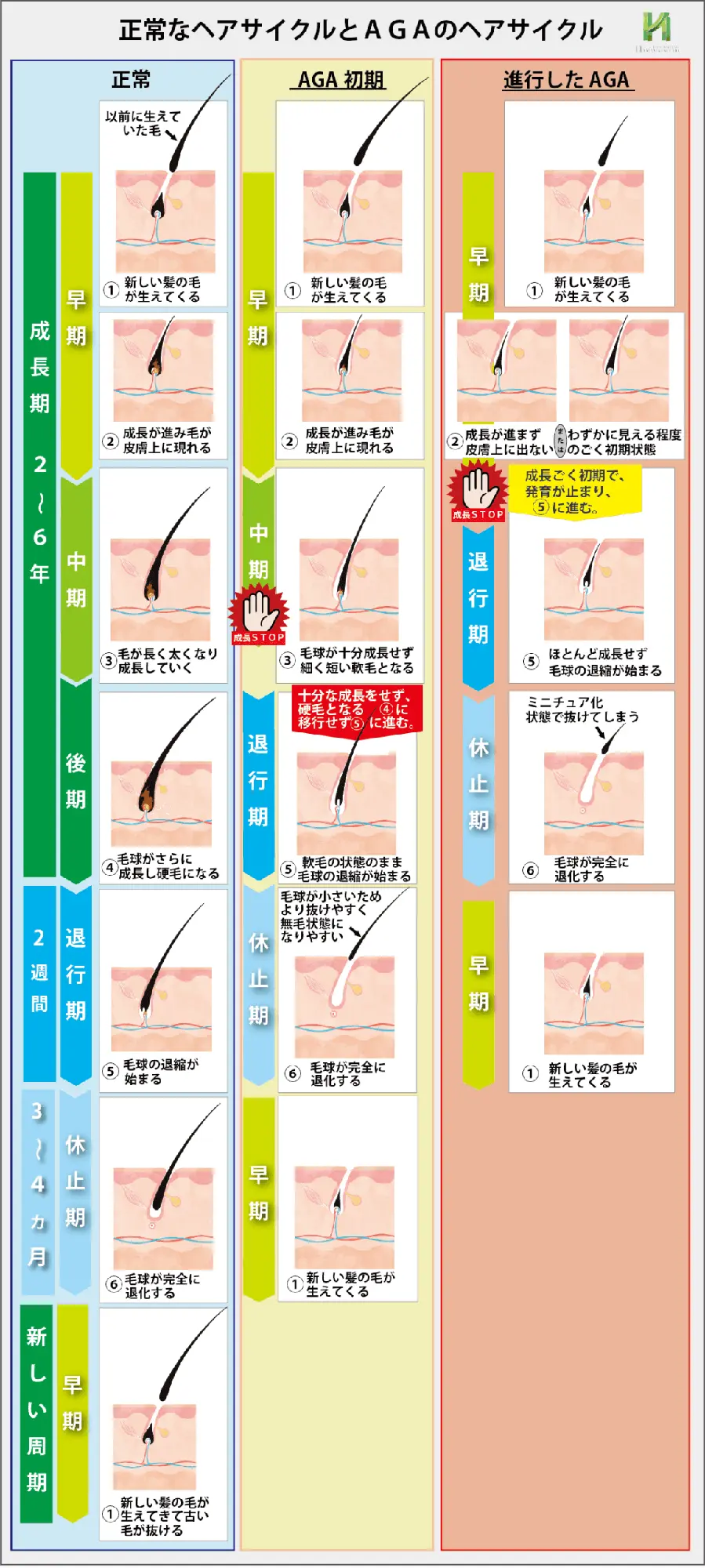 正常な毛周期とAGAの毛周期の違いを示す図解