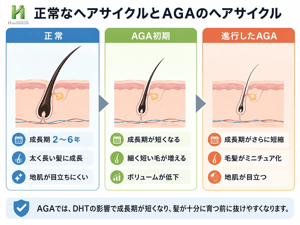 正常なヘアサイクルとAGAのヘアサイクルの違い(成長期短縮・毛髪のミニチュア化)を示す図解