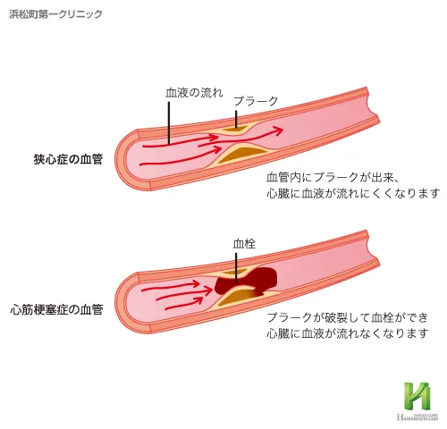 狭心症と心筋梗塞の違い