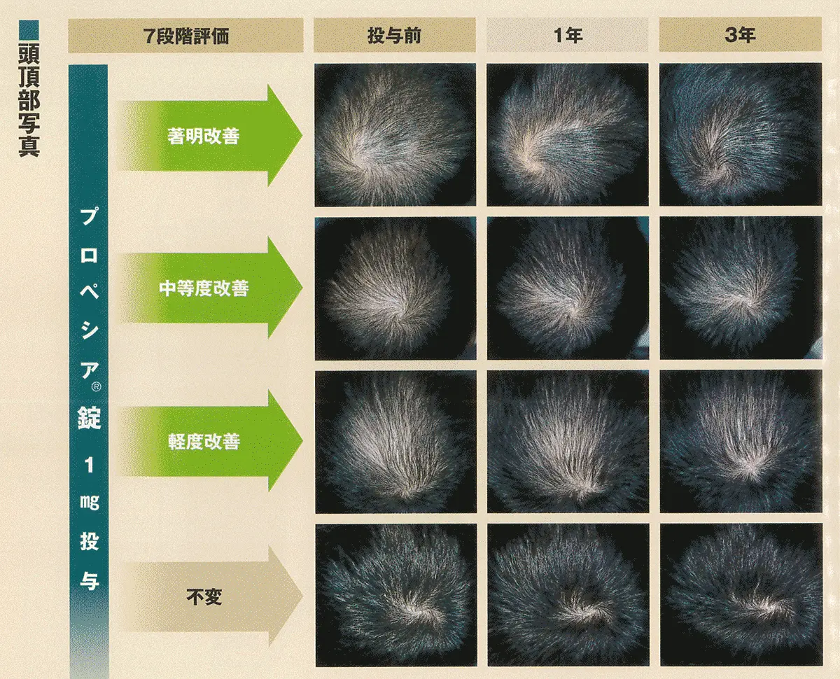 頭頂部の改善効果比較写真