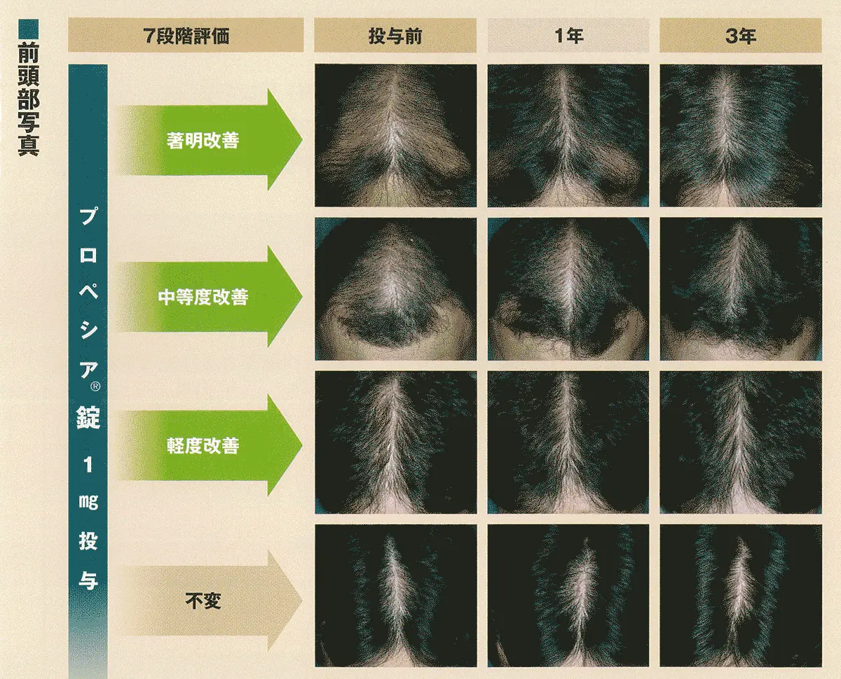 前頭部の改善効果比較写真