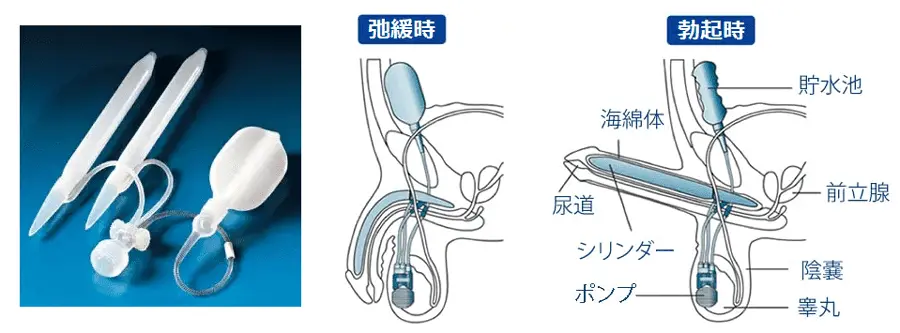 陰茎プロステーシス Titan OTR