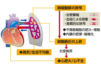 肺動脈性肺高血圧症