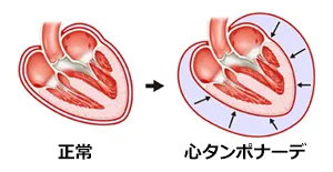 心タンポナーデ
